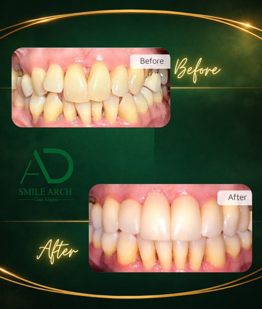 Smile transformation: gap closure